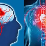 Difference between Stroke and Heart Attack