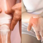 Osteoarthritis vs Rheumatoid Arthritis